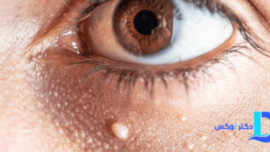 درمان میلیا با گلاب؛ حذف دانه‌های سفید زیر پوست