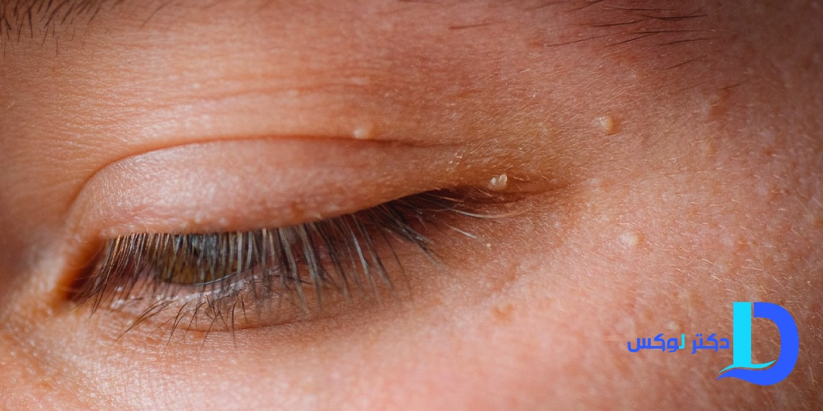 درمان میلیا با گلاب؛ حذف دانه‌های سفید زیر پوست