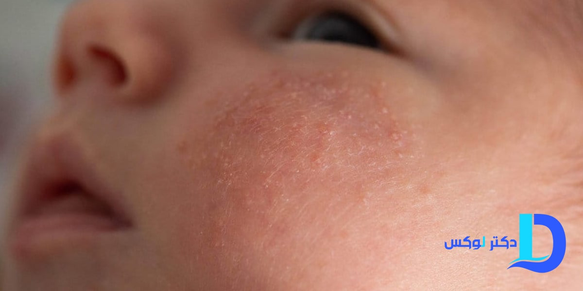 درمان میلیا با گلاب؛ حذف دانه‌های سفید زیر پوست